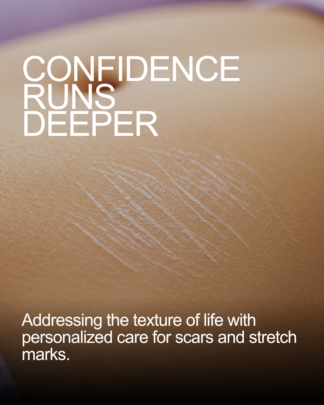 Stretch Marks & Scarring Treatment
