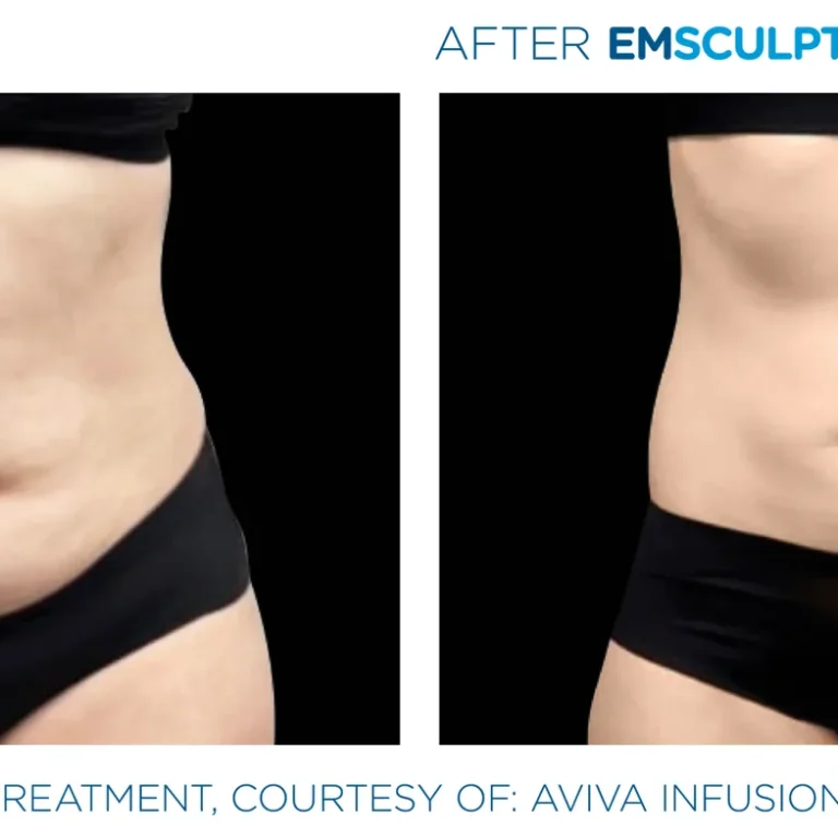 Emsculpt_Neo-Weight-Loss_PIC_Ba-card-female-abdomen-001_ENUS100-scaled-optimized-1